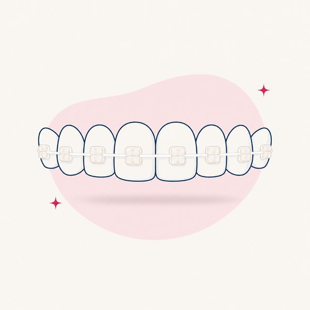 Illustration: Keramikbrackets